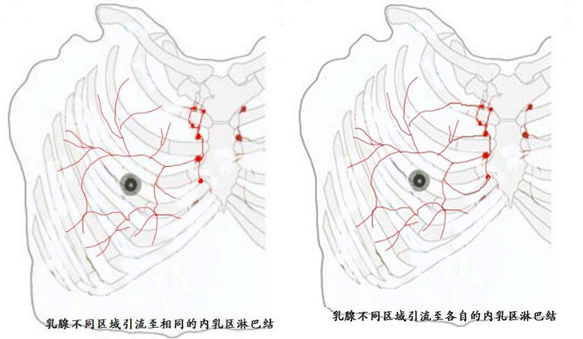 新技术引导的高显像率,精确分期乳腺癌内乳区前哨淋巴结活检术
